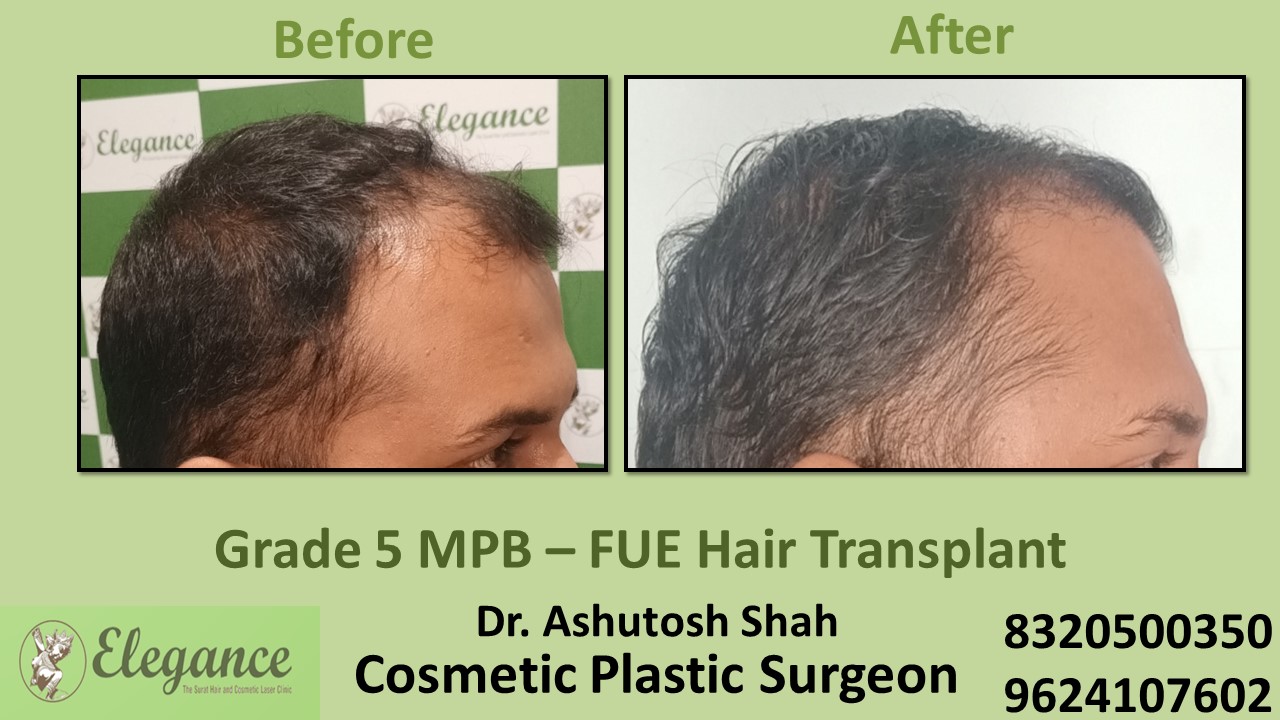 Hair Transplant Grade 5 Treatment, Hair Regrowth in  Athwagate, Surat