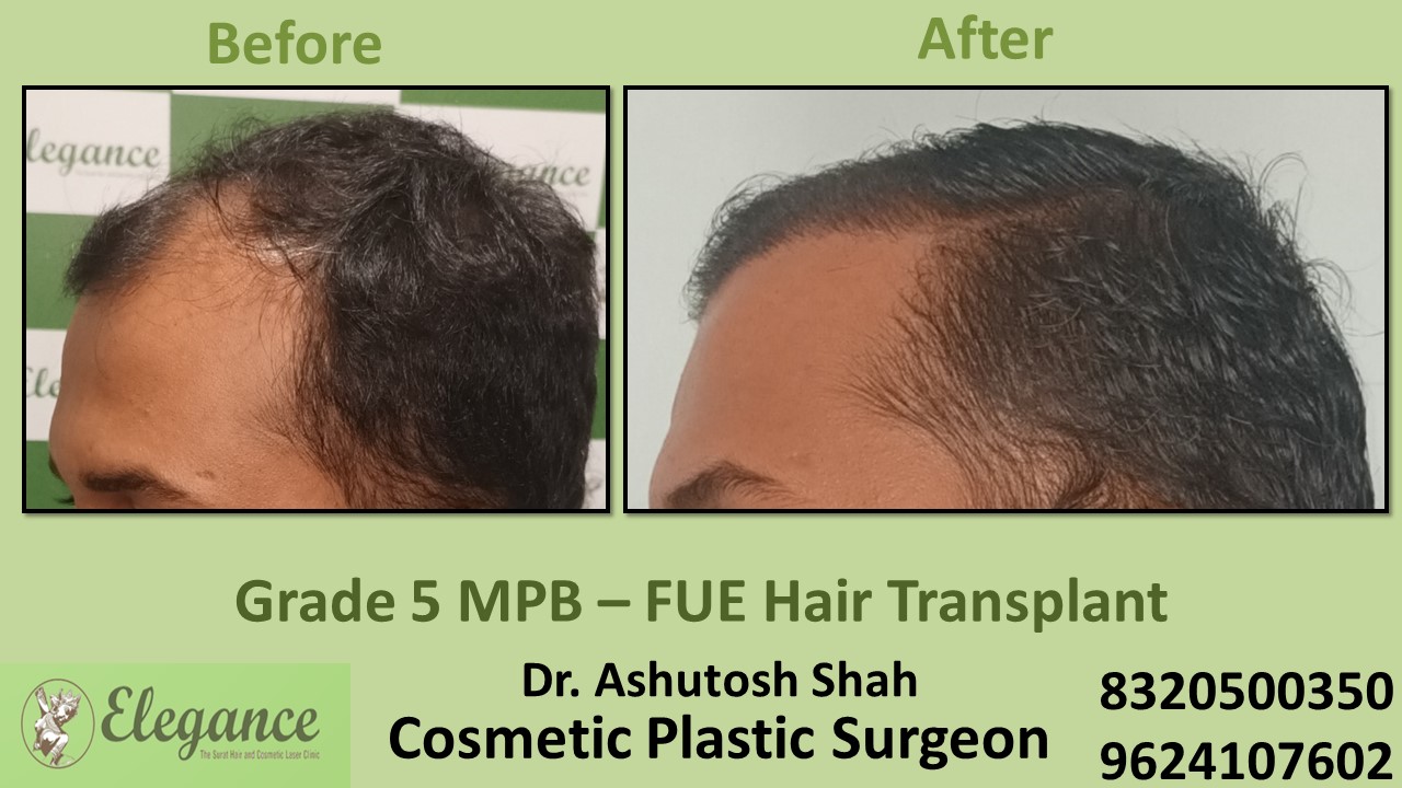 Hair Transplant Grade 5 Treatment, Hair Regrowth in Surat