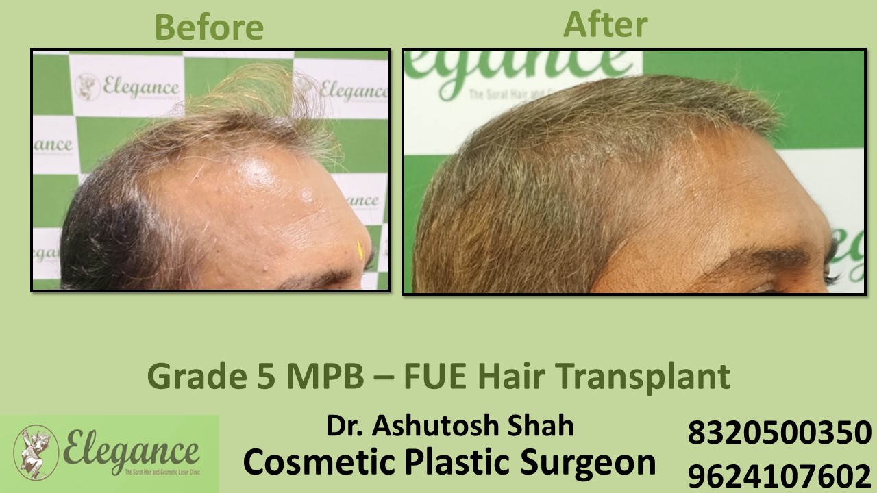 Hair Transplant Grade 5 Treatment, Hair Regrowth in Valsad, Surat