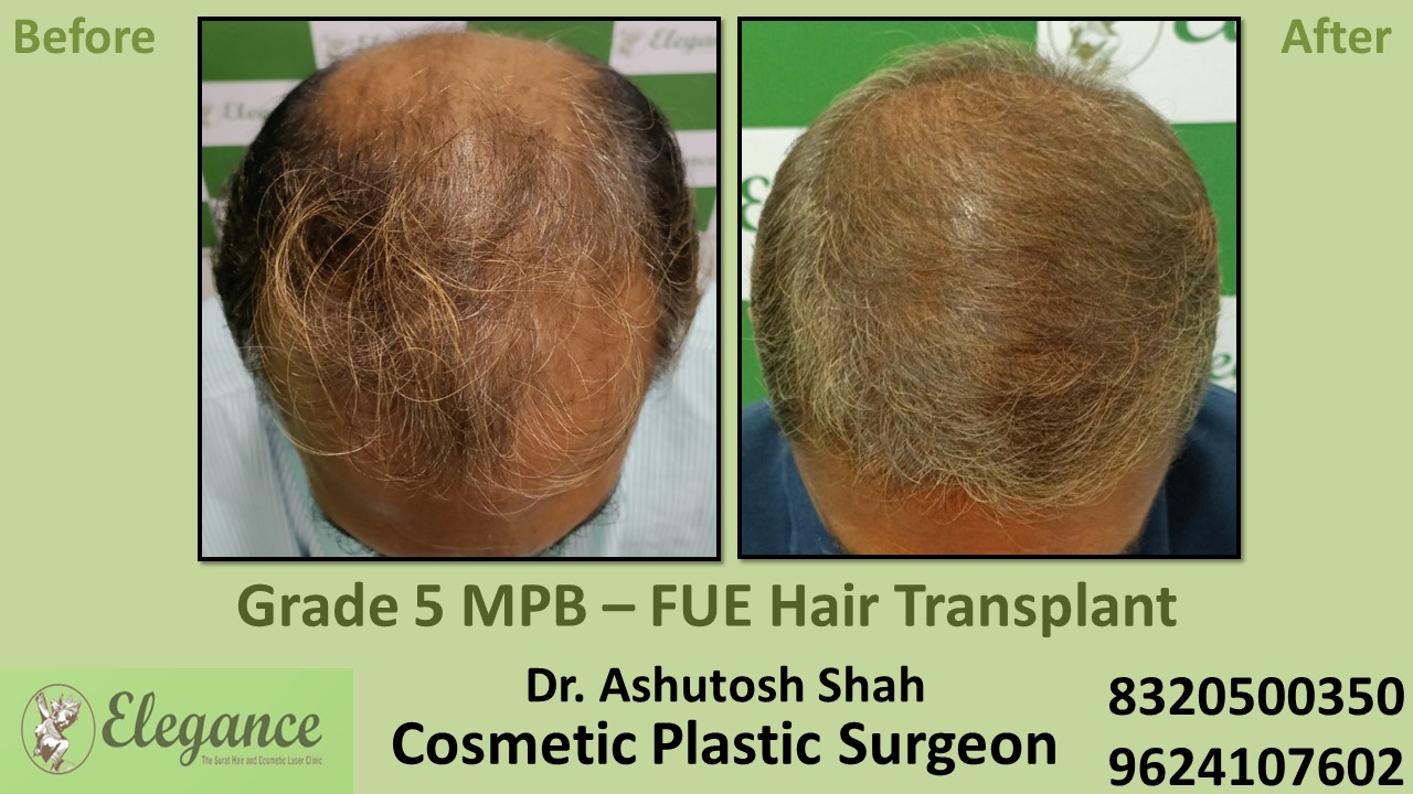 Hair Transplant Grade 5 Treatment, Hair Regrowth in Valsad, Vapi, Surat