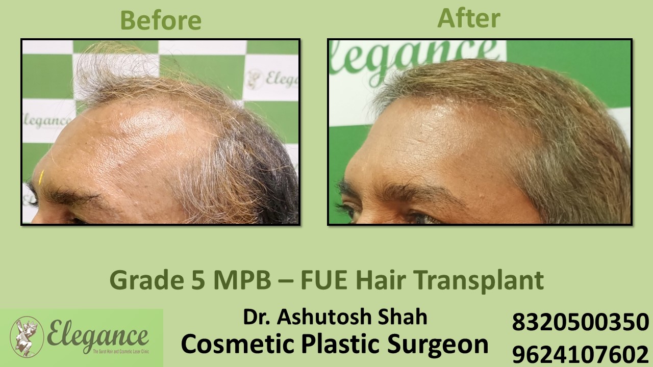 Hair Transplant Grade 5 Treatment, Hair Regrowth in Vapi, Surat
