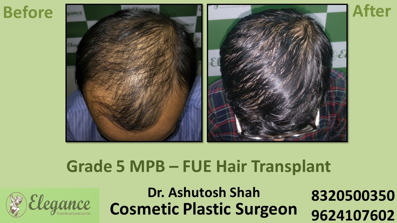 Hair Transplant Grade 5 Treatment, Hair Regrowth in Navsari, Surat