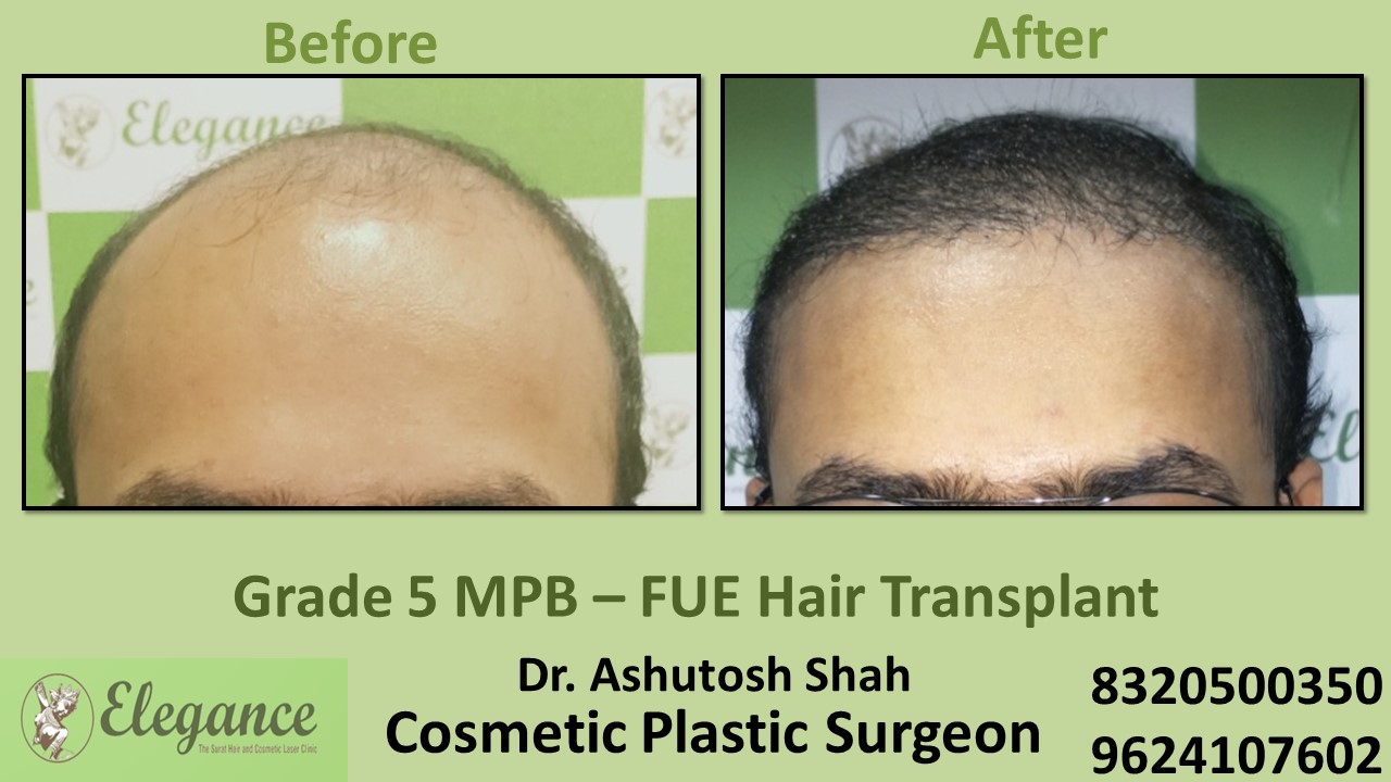 Hair Transplant Grade 5 Treatment, Hair Regrowth in Bardoli, Surat