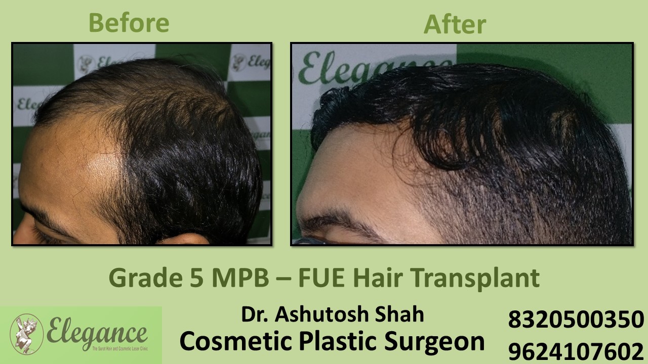 FUE Hair Transplant in Surat