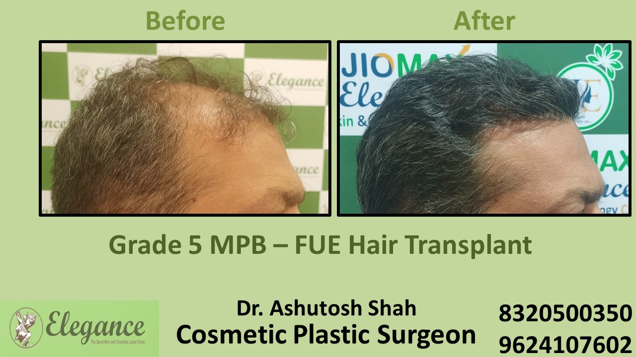 Hair Regrowth Treatment in Vesu, Surat