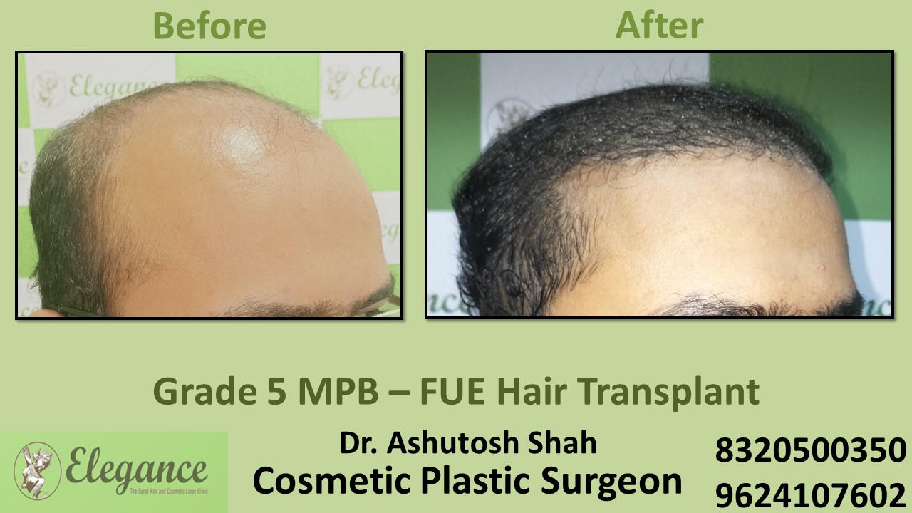 Hair Regrowth Treatment, Hair Baldness in Vesu, Surat