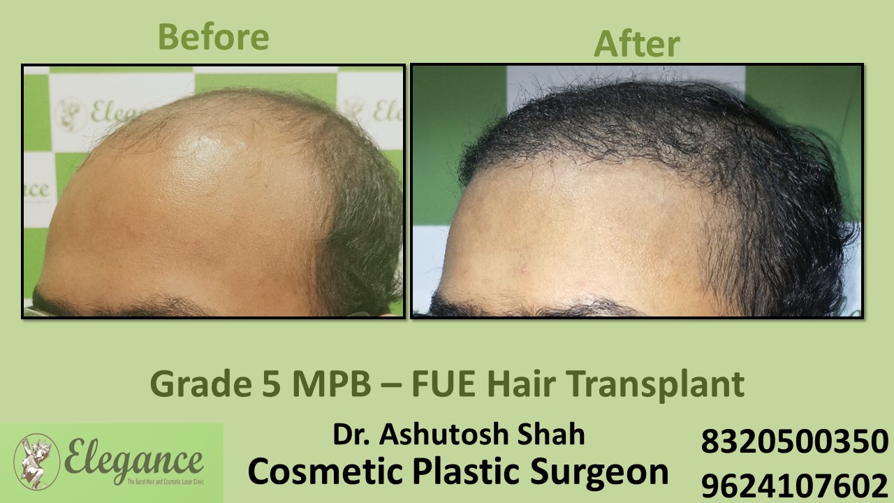 Hair Regrowth Treatment, Hair Baldness in Bharuch, Surat