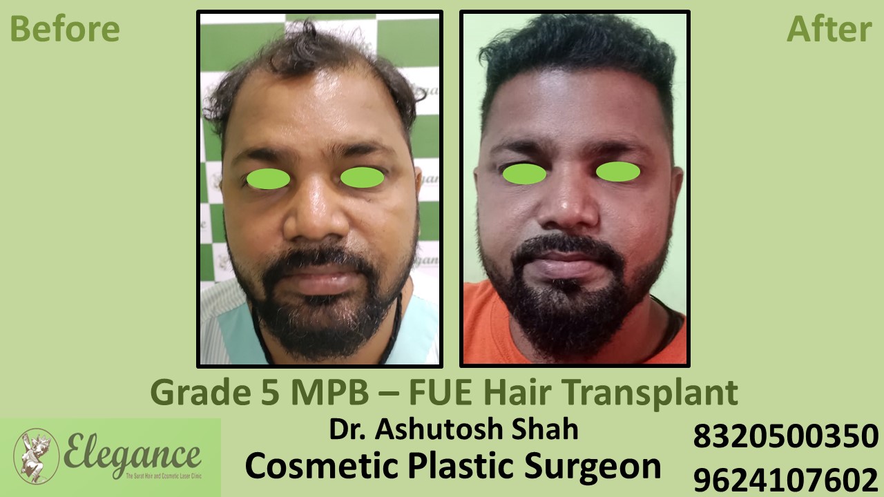 Hair Regrowth Treatment, Hair Baldness in Bharuch, Kim, Surat
