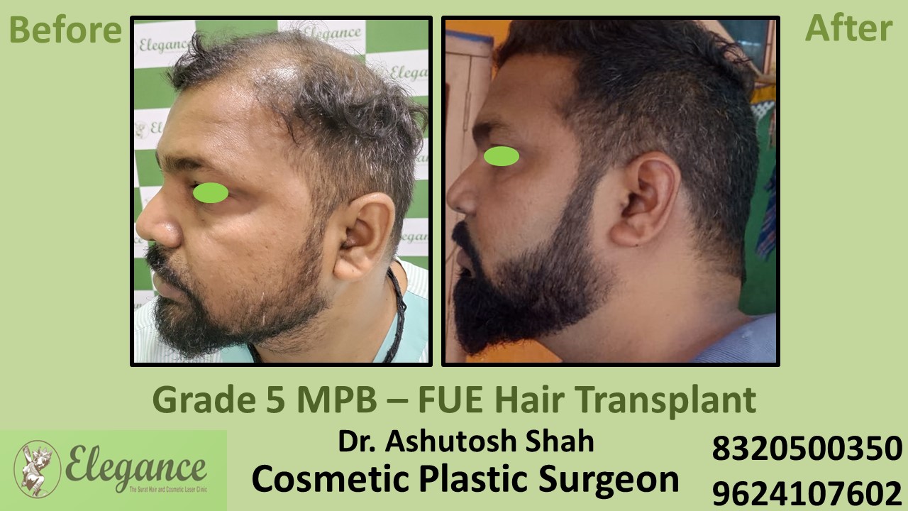 Hair Regrowth Treatment, Hair Baldness in  Kim, Surat