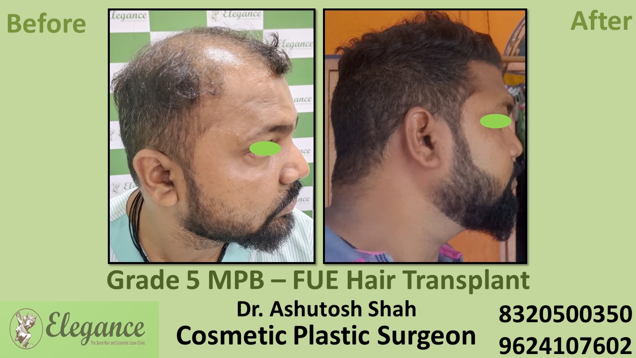 Hair Regrowth Treatment, Hair Baldness in  Ankleshwar, Surat