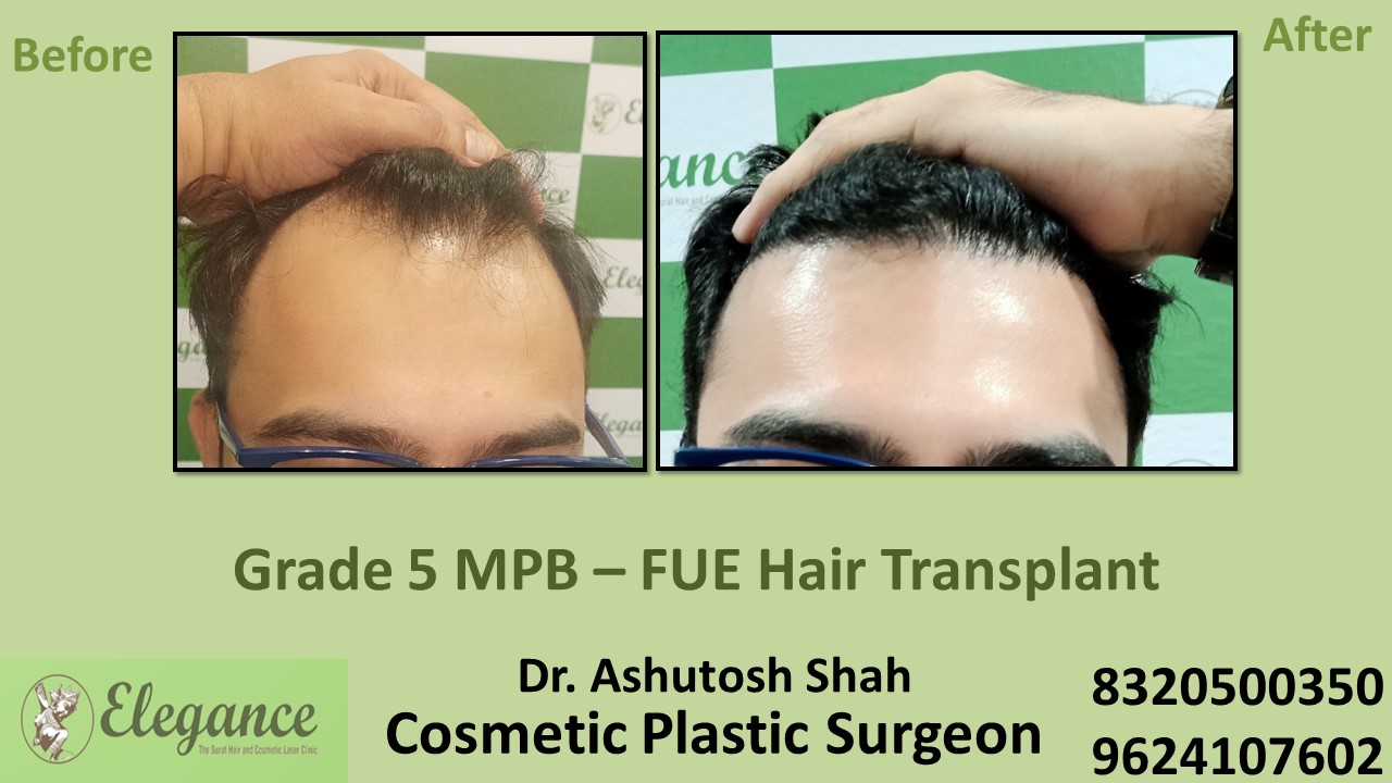 Hair Regrowth Treatment, Hair Baldness in  Anand, Surat