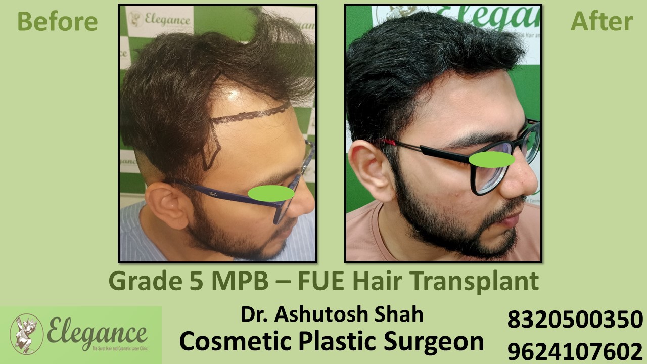 Hair Regrowth Treatment, Hair Baldness in  Vesu, Dumas, Surat