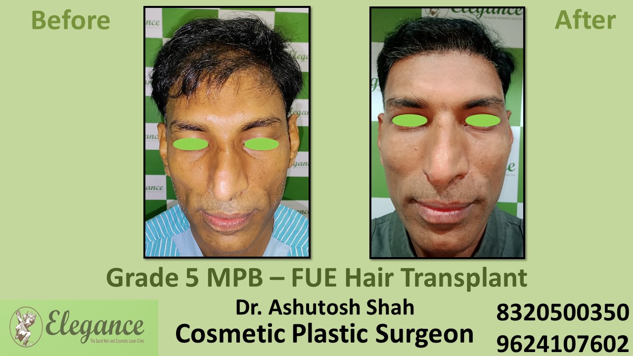 FUE Hair Transplant, Grade 5,  Baldness Treatment in Vesu, Surat