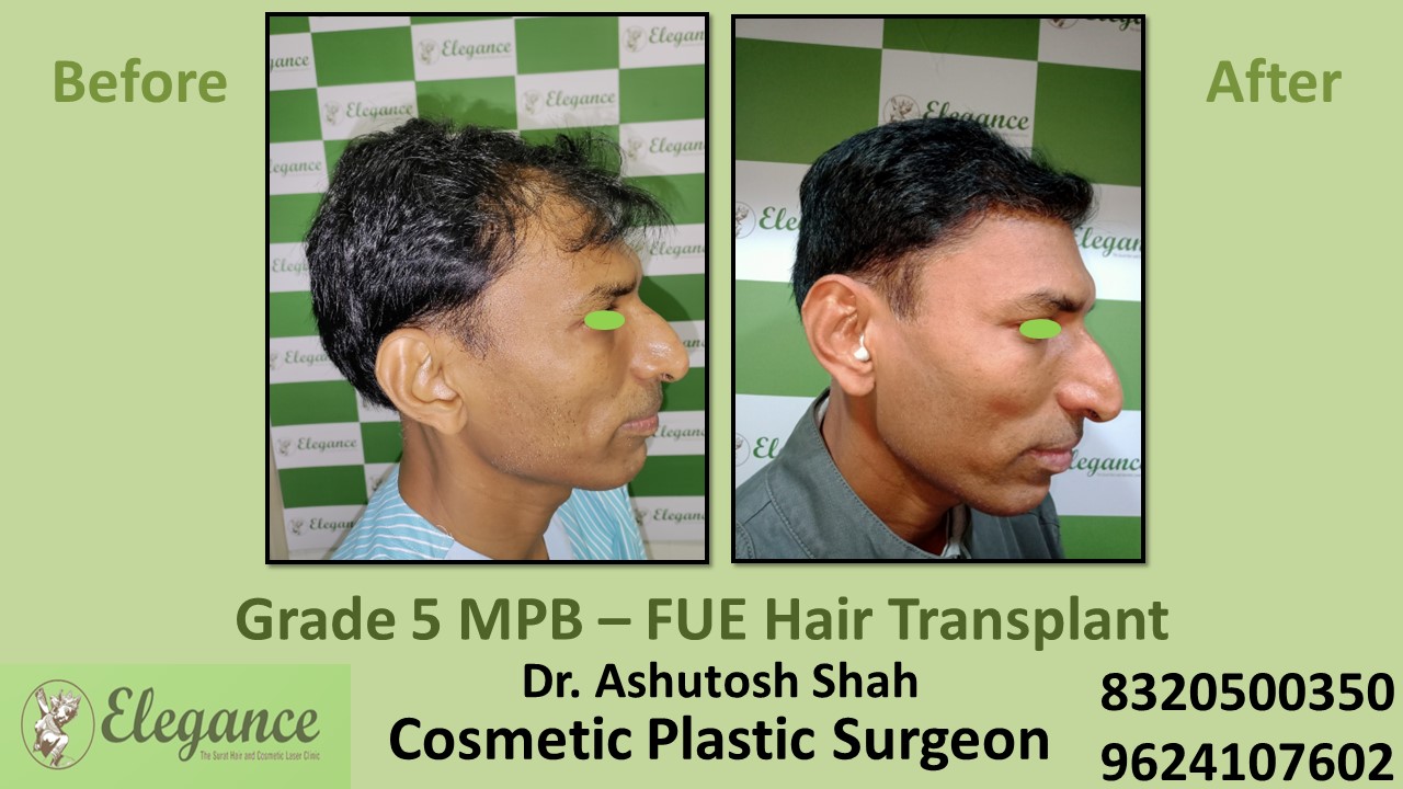 Grade 5 Baldness Hair Transplant With FUE Method | Hair Baldness, Hair Transplant in Kim, Surat