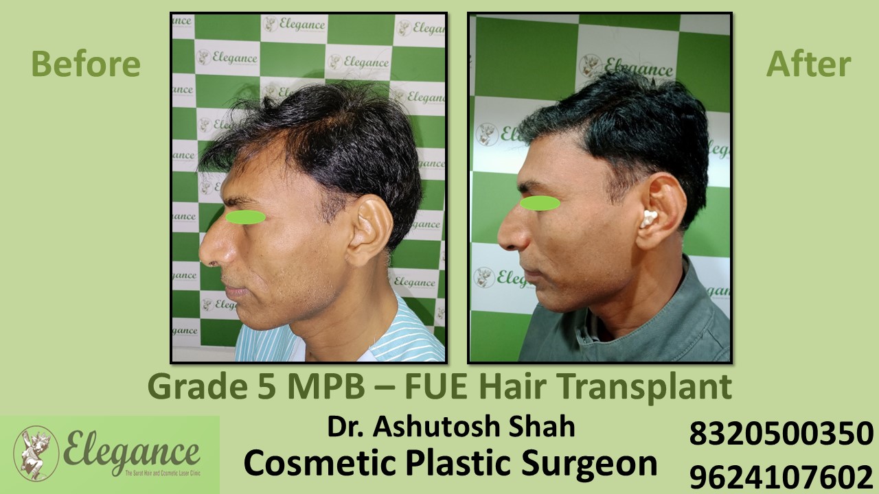Grade 5 Baldness Hair Transplant With FUE Method | Hair Baldness, Hair Transplant in Valsad, Kim, Surat