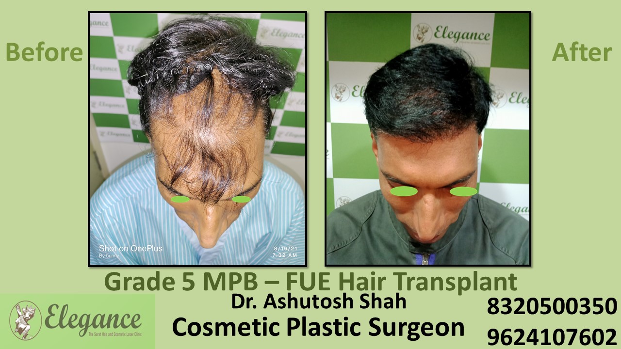 Grade 5 Baldness Hair Transplant With FUE Method | Hair Baldness, in Valsad, Surat