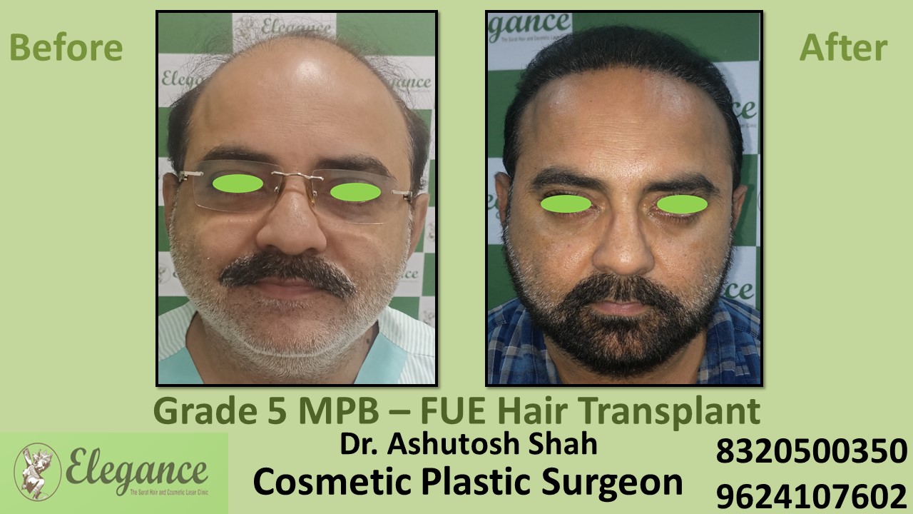 Grade 5 Baldness Hair Transplant With FUE Method | Hair Baldness, in Kosamba, Surat