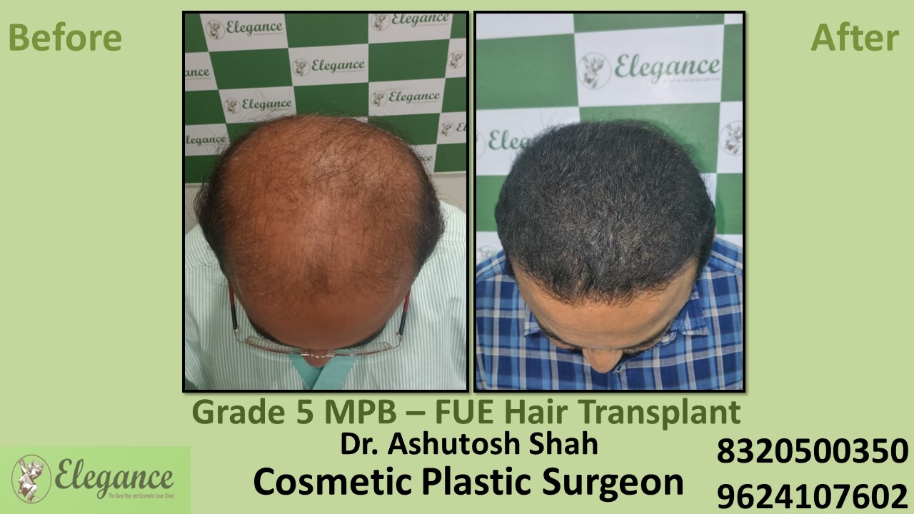 Grade 5 Baldness Hair Transplant With FUE Method, in Kosamba, Surat