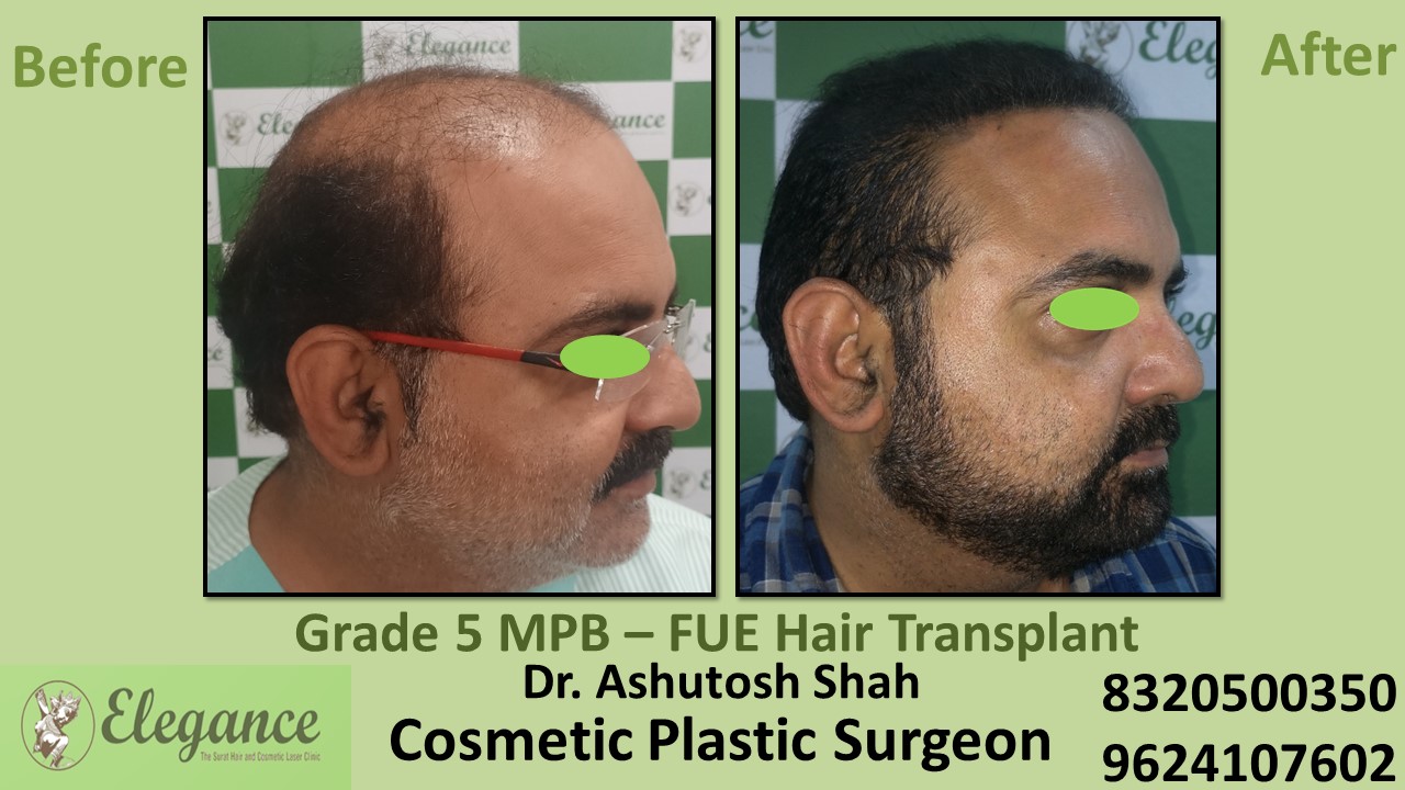 Grade 5 Baldness Hair Transplant With FUE Method, in Kim, Surat