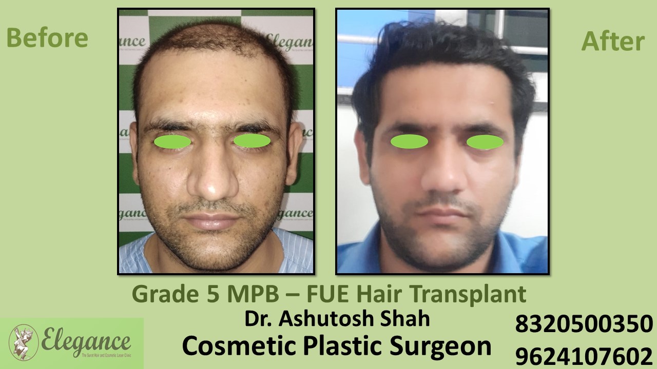 Grade 5 Baldness Hair Transplant With FUE Method, in Vapi, Valsad, Surat