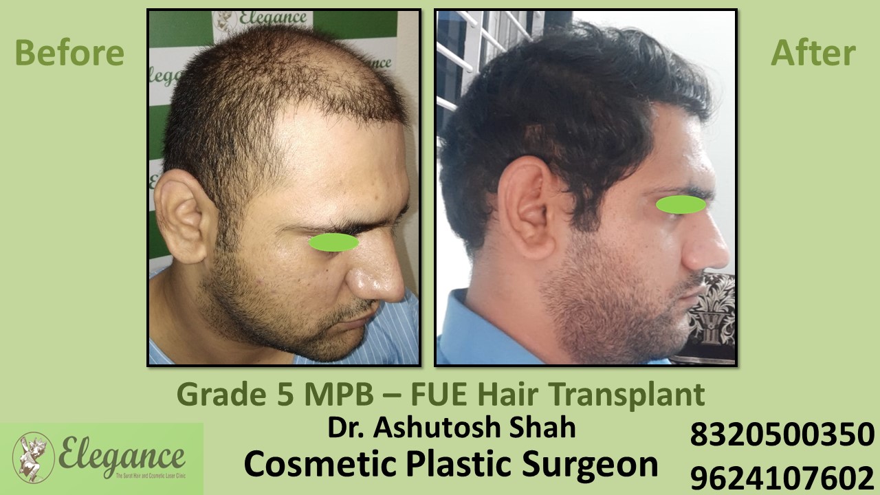 Grade 5 Baldness Hair Transplant With FUE Method, in Vesu, Surat