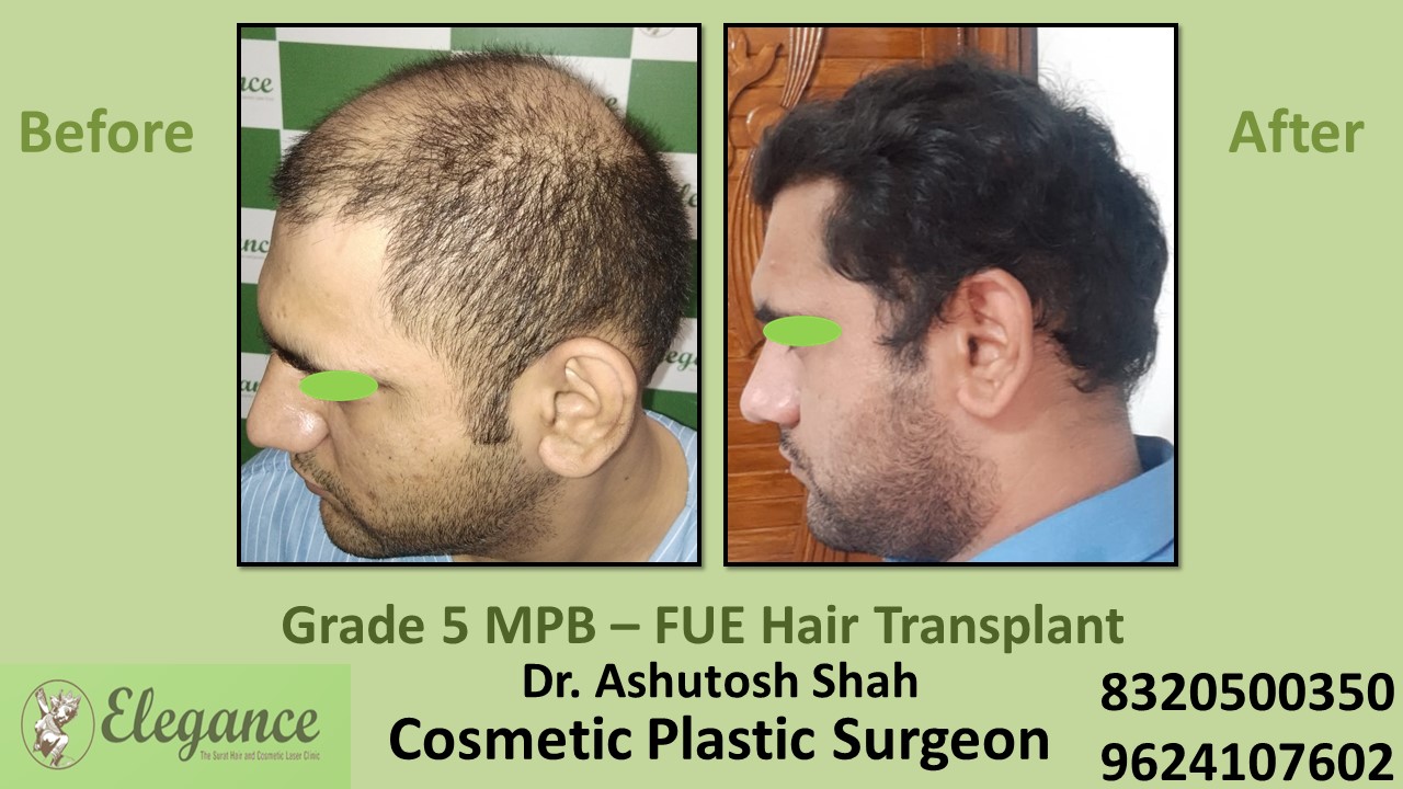 Grade 5 Baldness Hair Transplant With FUE Method, in Vesu, Athwagate, Surat