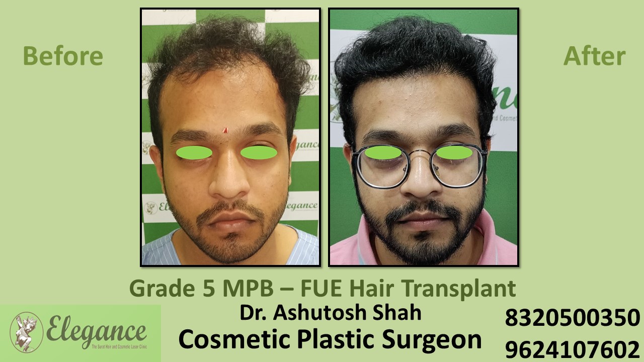 Hair Transplant with FUE Method, Hair Regrowth Treatment in Vesu, Surat