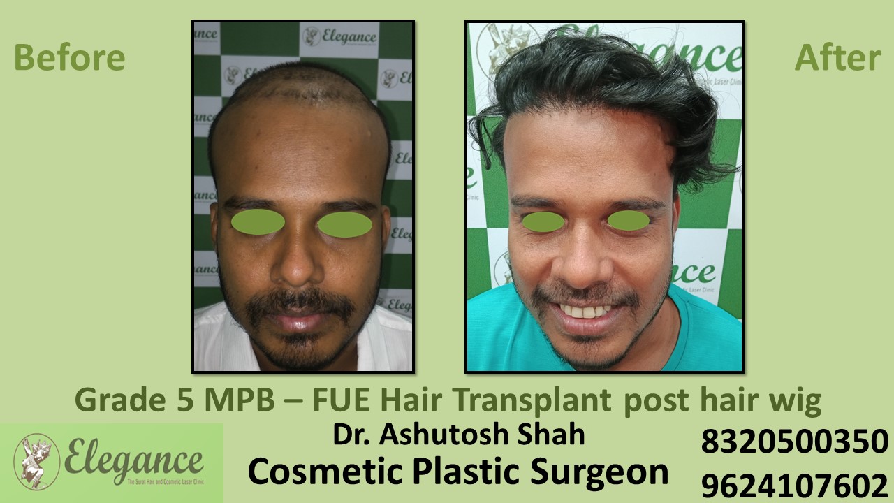 Hair Transplant with FUE Method, Hair Regrowth Treatment in Vesu, Athwagate, Surat