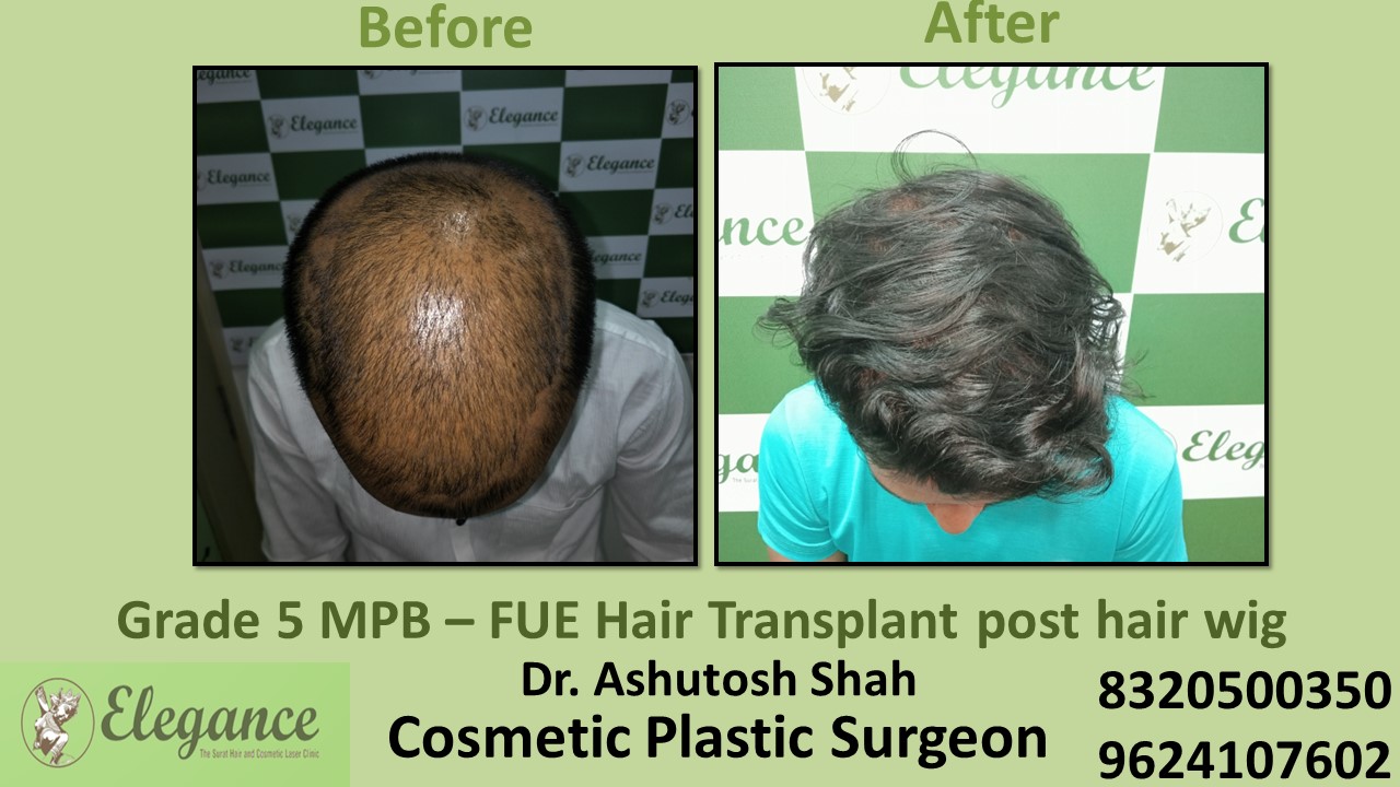 Hair Transplant with FUE Method, Hair Regrowth Treatment in Athwagate, Surat