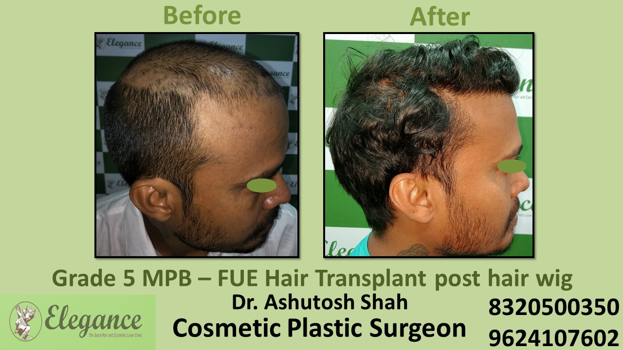 Hair Transplant with FUE Method, Hair Regrowth Treatment in Piplod, Surat