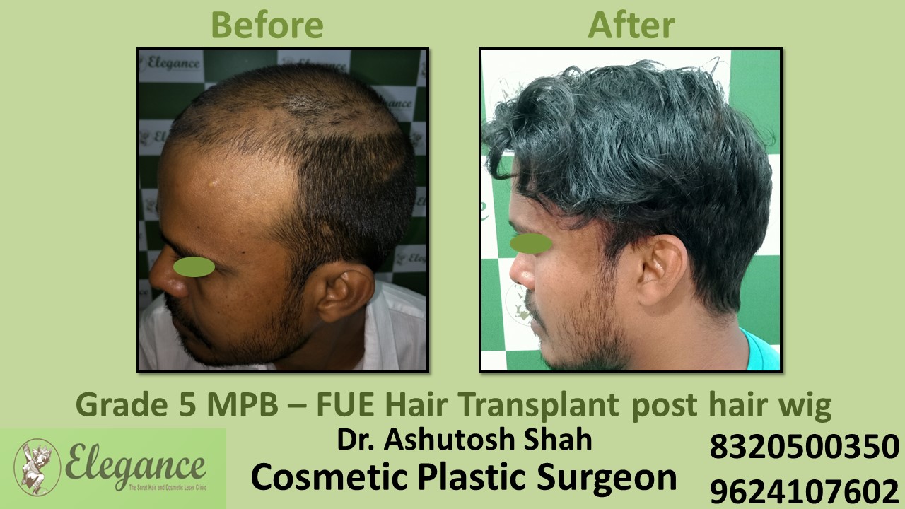 Hair Transplant with FUE Method, Hair Regrowth Treatment in Parle Point, Surat