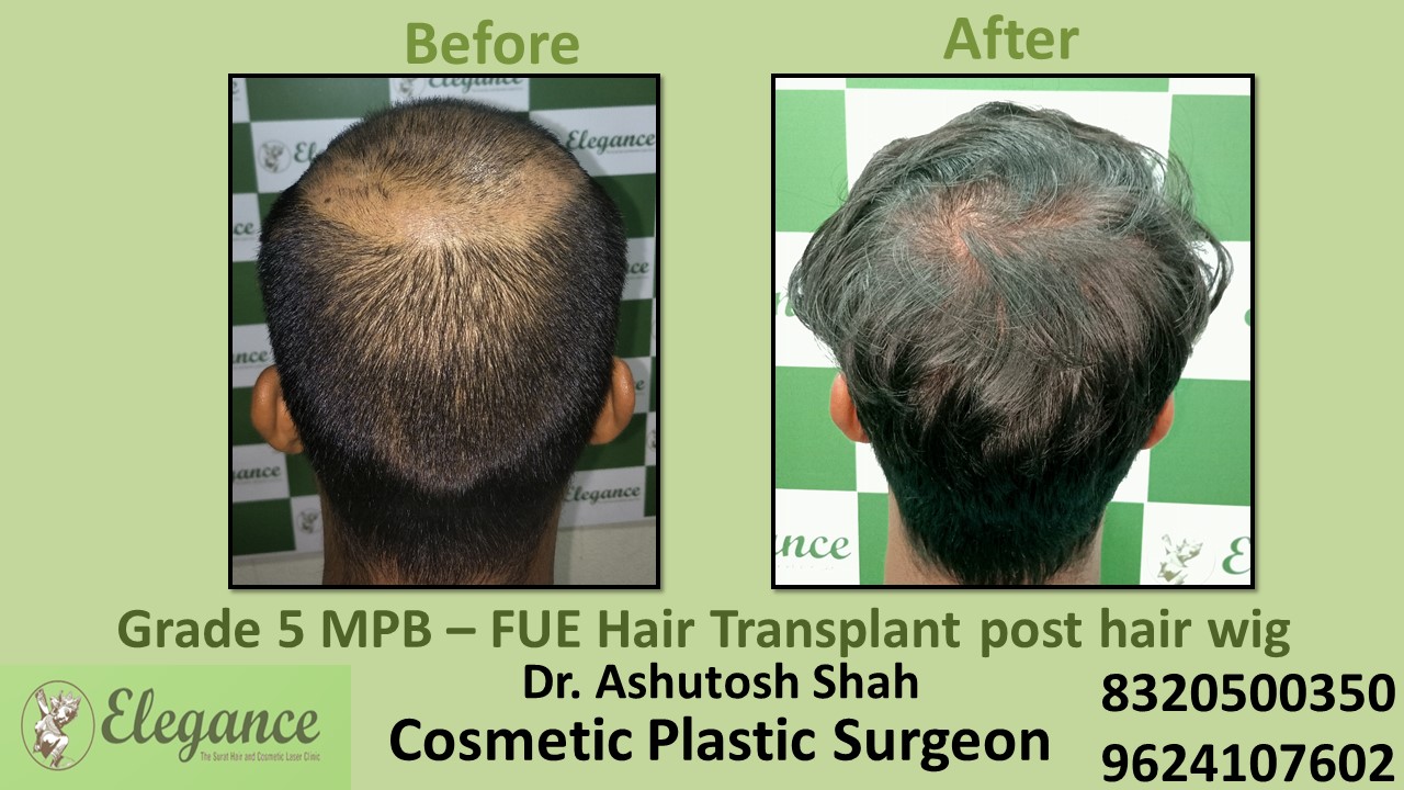 Hair Transplant with FUE Method, Hair Regrowth Treatment in Pal, Surat