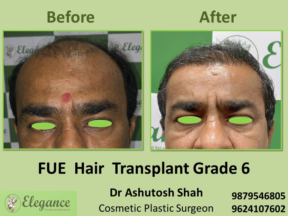 Fue Method, Grade 6 Hair Transplant in Vesu, Surat