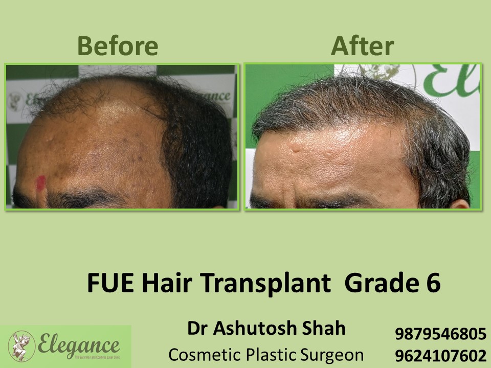 Hair Baldness, Grade 6, Hair Transplant in Surat
