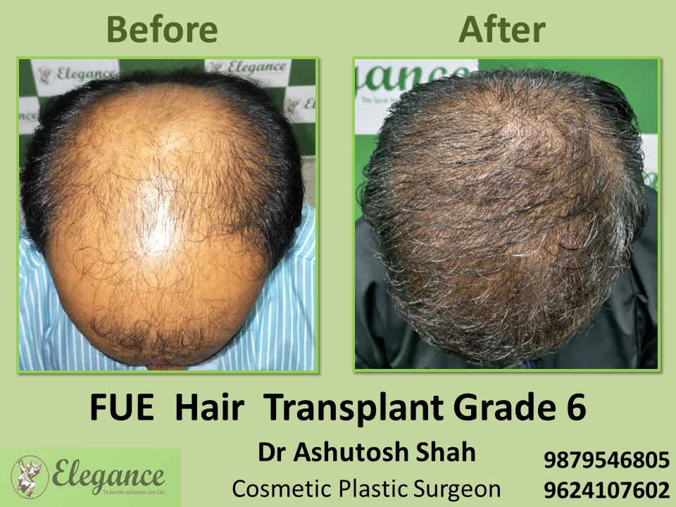 Hair Regrowth, Grade 6, Hair Transplant in Adajan, Surat