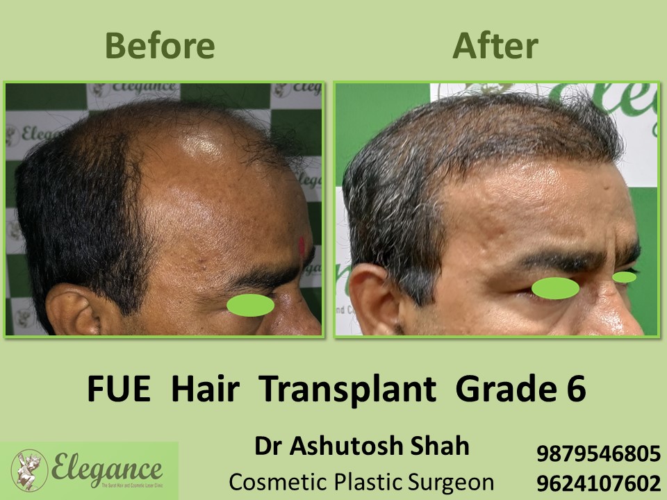 Hair Regrowth, Grade 6, Hair Transplant in Pal, Surat
