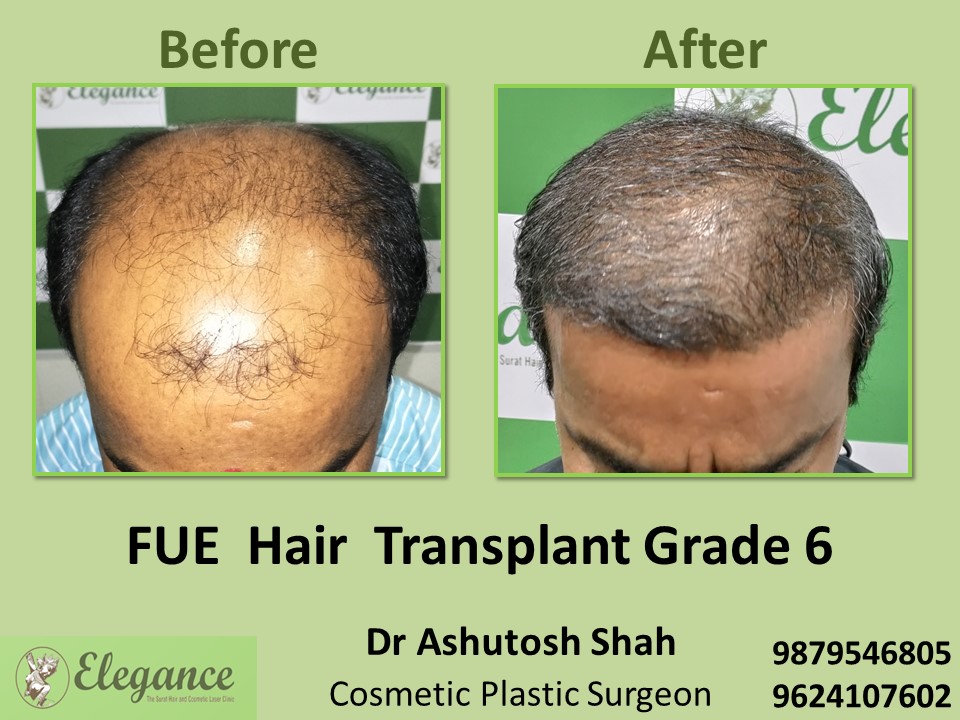 Hair Regrowth, Grade 6, Hair Transplant in Surat