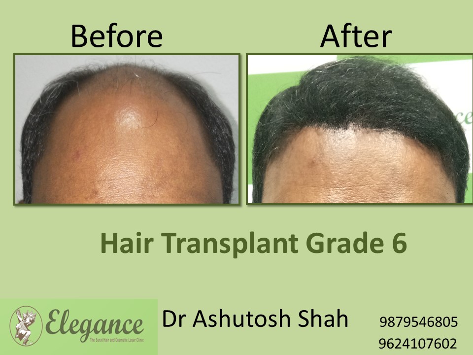 Grade 6 Hair Transplant In Surat, Gujarat, India