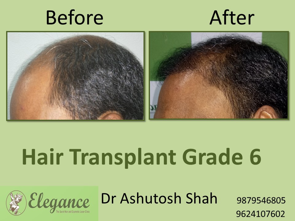 Grade 6 Hair Transplant Cost In Surat, Gujarat, India