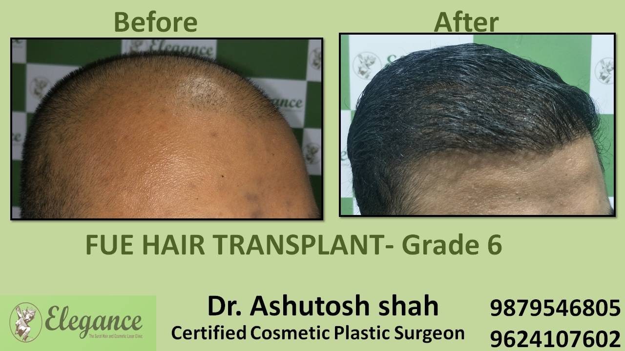 Hair Transplant grade 6 Before And After Surat, Gujarat, India