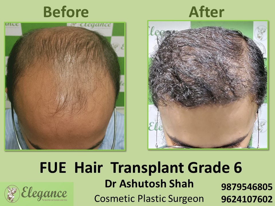 Grade 6, FUE Method, Hair Baldness in Adajan, Surat