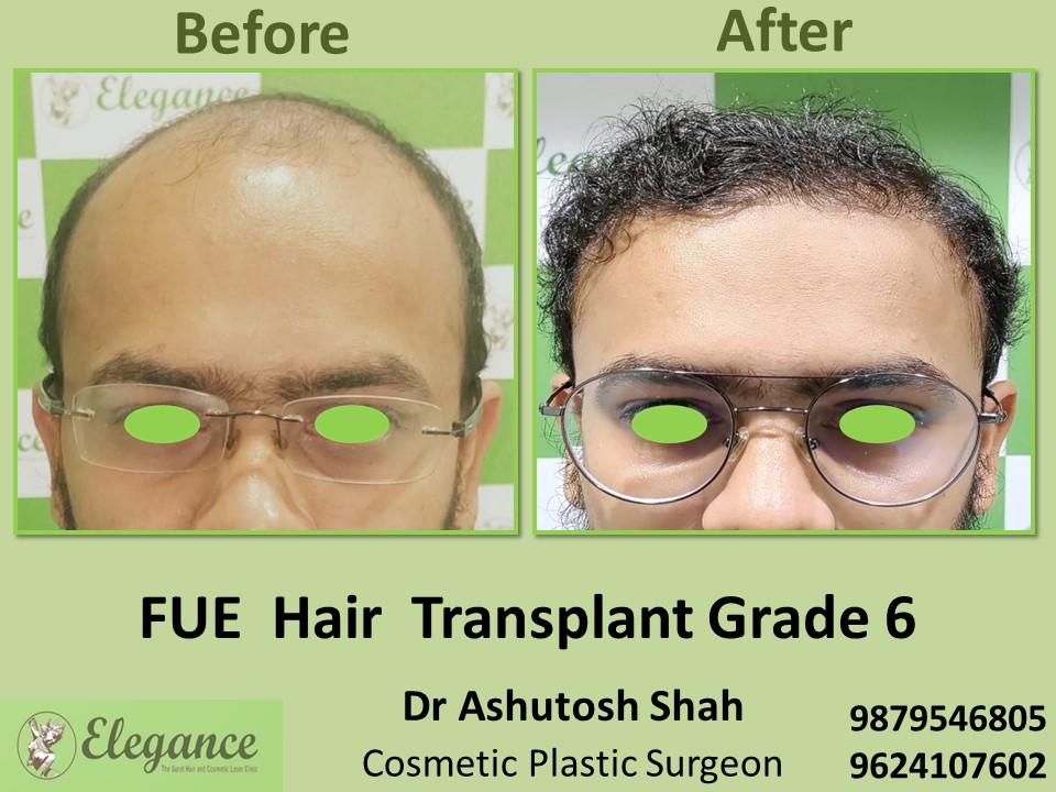 Grade 6, FUE Method, Hair Baldness in Vesu, Adajan, Surat