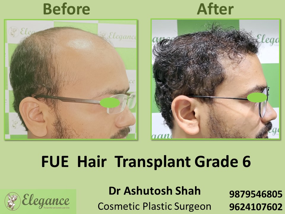 Grade 6, FUE Method, Hair Baldness in Vesu, Piplod, Surat