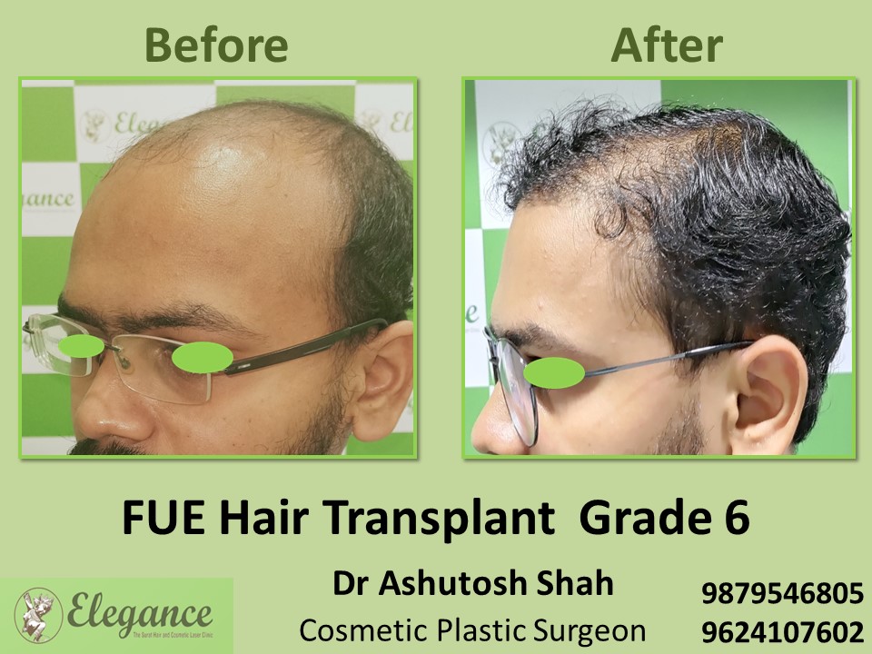 Grade 6, FUE Method, Hair Baldness in Vesu, Surat