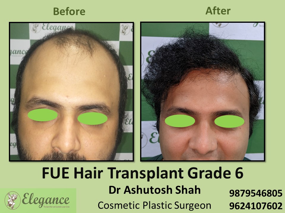 Grade 6, Hair Transplant, FUE Method in Adajan, Surat