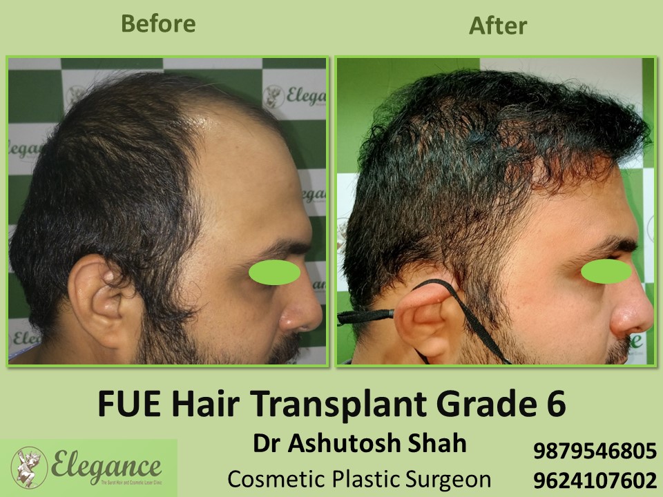 Grade 6, Hair Transplant, FUE Method in Pal, Adajan, Surat