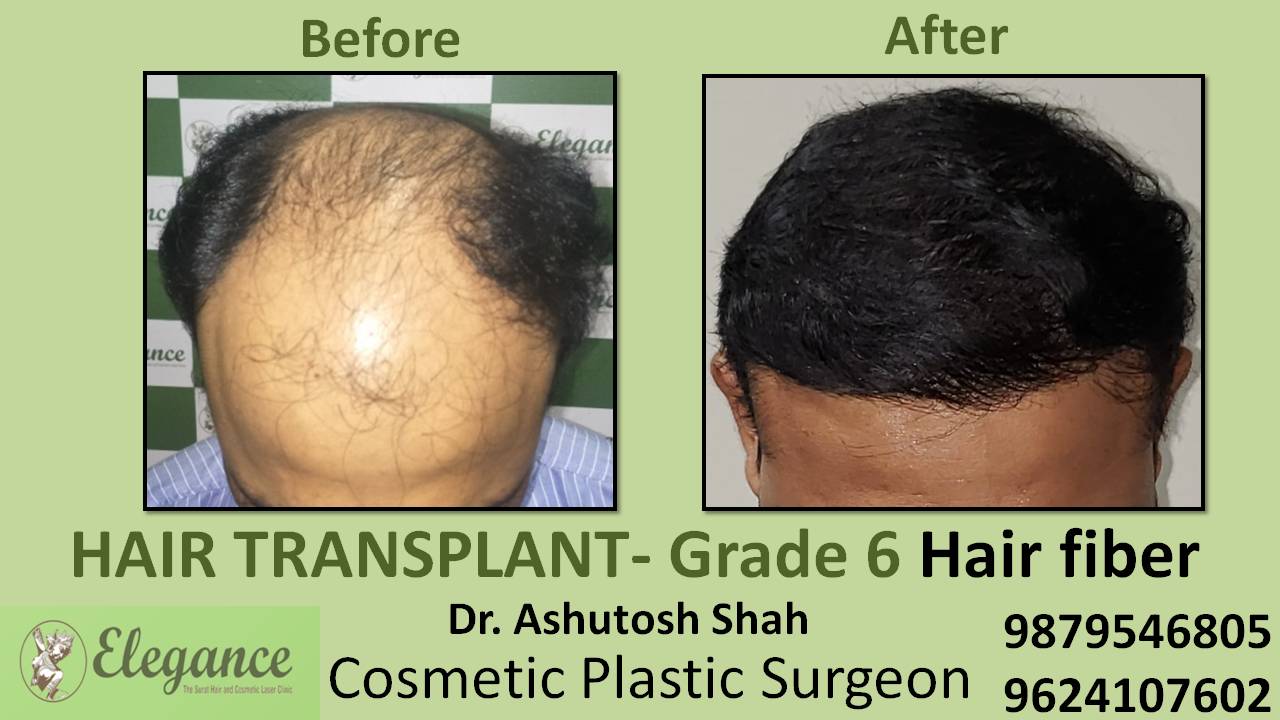 Hair Transplant grade 6 Rajkot, Gujarat, India
