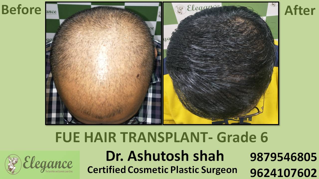 Hair Transplant grade 6 In Ahmadabad, Gujarat, India