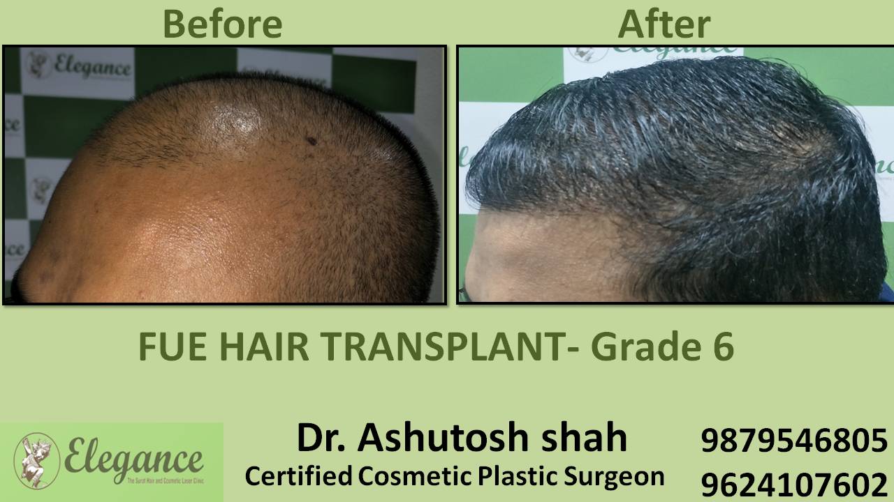 Hair Transplant grade 6 In Anand, Gujarat, India