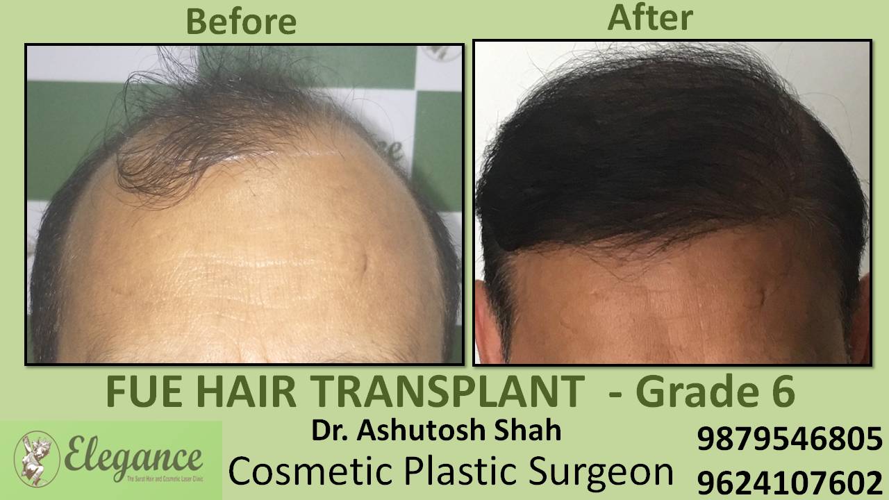 Hair Transplant grade 6 In Bharuch, Gujarat, India